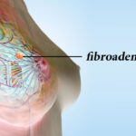 هر آنچه باید درباره فیبروآدنوما بدانید